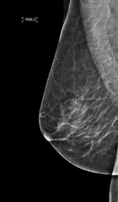 Mammographie Schrägaufnahme