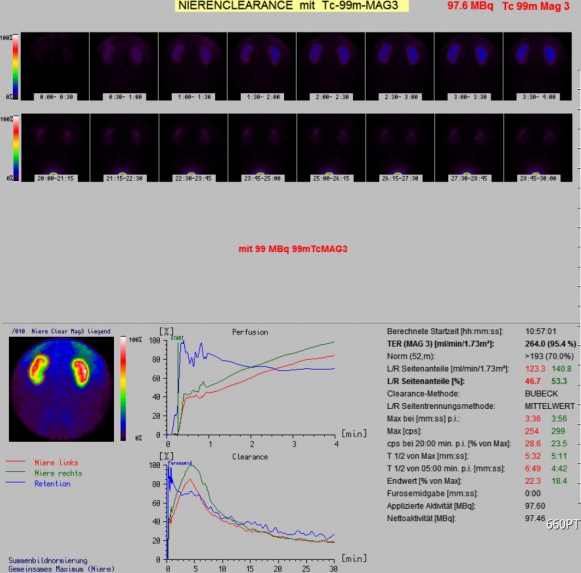 Nierenszintigraphie.jpg