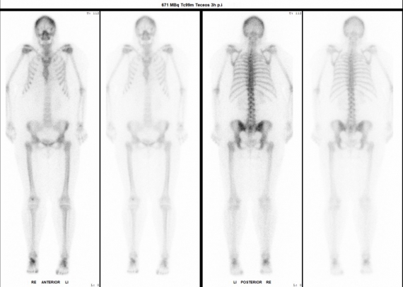 Knochenszintigraphie.jpg