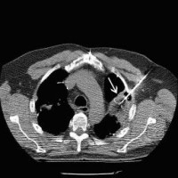 Thermoablation1