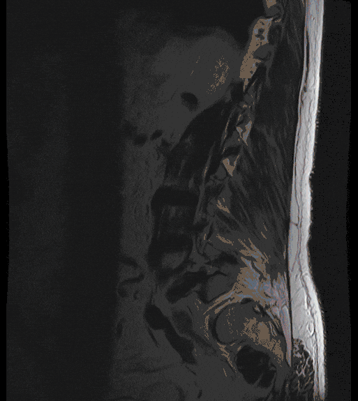 Spinalkanalstenose Spinalkanalstenose